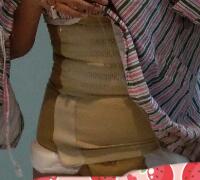 抽脂减肥瘦腰腹亲身经历和前后对比图分享