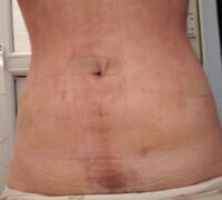 抽脂减肥瘦腰腹亲身经历和前后对比图分享