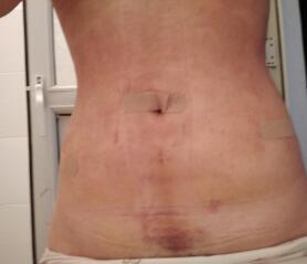 吸脂减肥瘦身果图