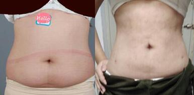 抽脂减肥前后果图对比