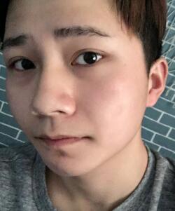 注射注射瘦脸B****恢复图