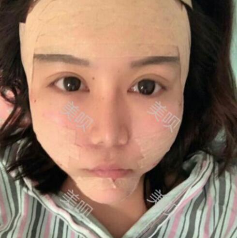 自体脂肪面部填充后年轻了好几岁呢