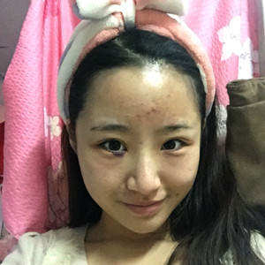 祛眼袋半年了，晒晒我的恢复前后对比果图片哦