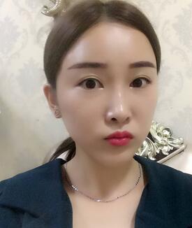爱悦丽格玻尿酸丰苹果肌、丰下巴、隆鼻