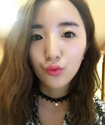 爱悦丽格玻尿酸丰脸颊日记分享