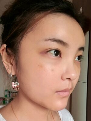 自体脂肪面部填充之后饱满又自然，广州曙光刘永波做哒