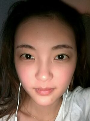 自体脂肪面部填充之后饱满又自然，广州曙光刘永波做哒