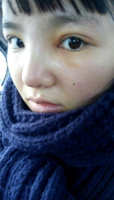 假体隆鼻加耳软骨垫鼻尖让我变成巴拉拉小魔仙