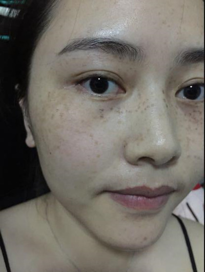 皮肤美容激光祛斑让我基本告别小雀斑