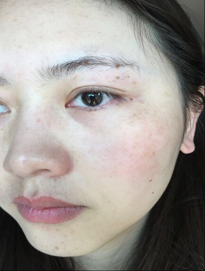 皮肤美容激光祛斑让我基本告别小雀斑