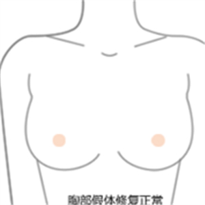 老妈隆胸失败假体取出，还是自然点好~