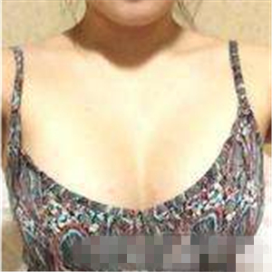 老妈隆胸失败假体取出，还是自然点好~