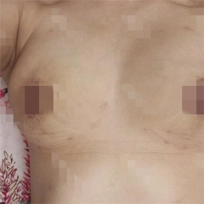 去年做的乳房下垂矫正手术，恢复照片给你们看看呢~