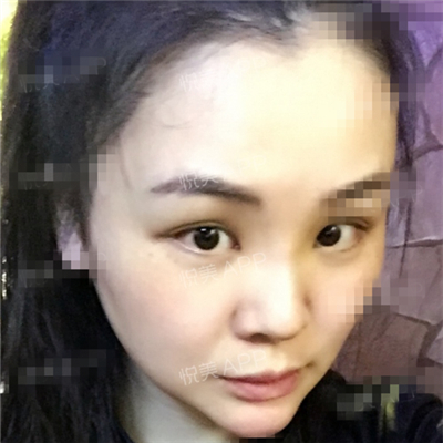 面部奥美定取出手术前后对比果图片分享，铜雀台做的呢~