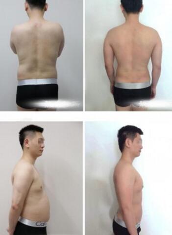 吸脂减肥前后对比图