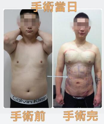 吸脂减肥前后对比图