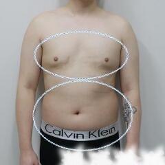 吸脂减肥手术瘦身，也算一个正能量胖子逆袭的故事吧