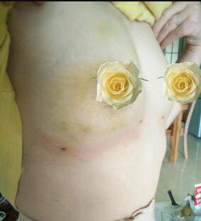 胸部整形之自体脂肪隆胸术后3个月恢复效果图分享