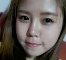 玻尿酸除皱抗衰老去法令纹真实案例分享