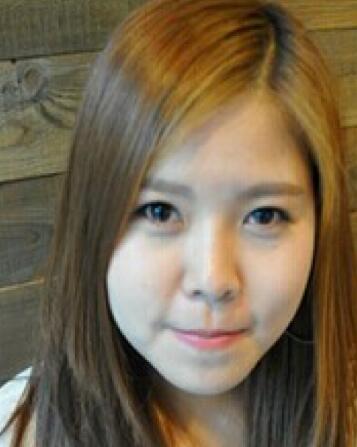 玻尿酸去法令纹之前的照片