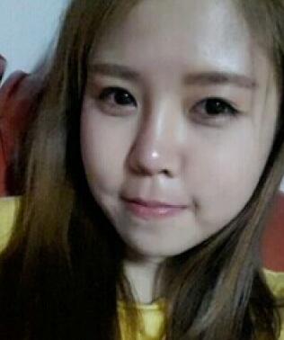 玻尿酸后，法令纹明X减轻了很多