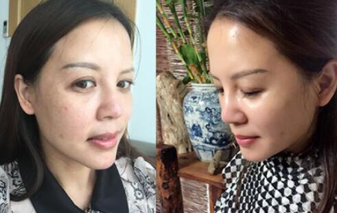 蛋白埋埋蛋白线.提升手术前后对比照片