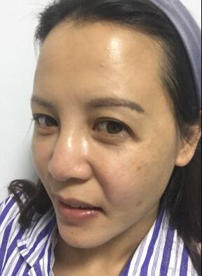 蛋白埋埋蛋白线.提升手术前照片