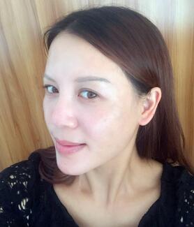 蛋白埋埋蛋白线.提升手术前后对比照片，术后第(一)天