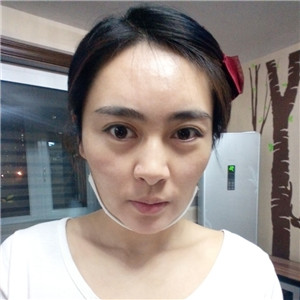 光纤溶脂去双下巴脸型更好看了