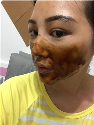 自体脂肪隆眉弓后，更有精神了