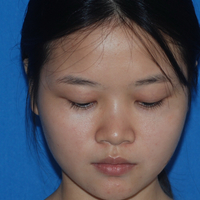 玻尿酸隆鼻改变了大鼻翼给大家分享下我的恢复过程