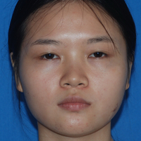 玻尿酸隆鼻改变了大鼻翼给大家分享下我的恢复过程