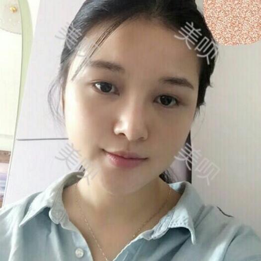 玻尿酸隆鼻改变了大鼻翼给大家分享下我的恢复过程