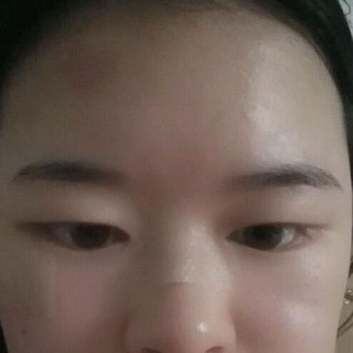 分享手术切除祛疤恢复过程希望对大家有帮助