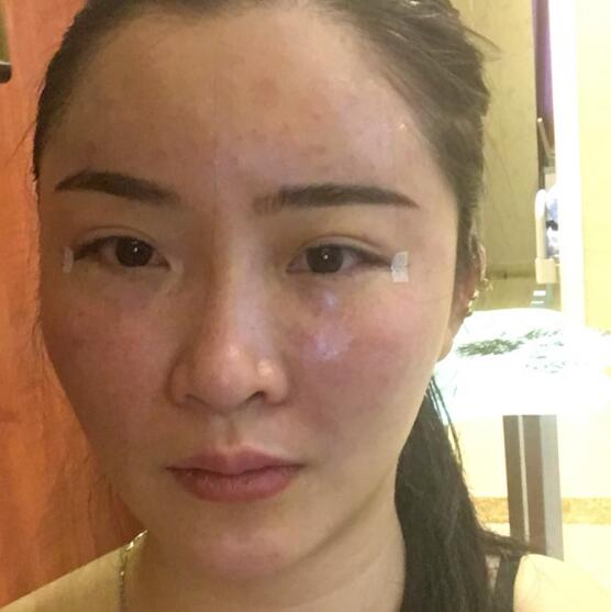 分享我的去胎记过程遗传性雀斑终于被甩掉了