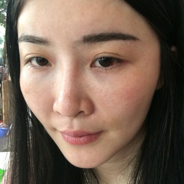 分享我的去胎记过程遗传性雀斑终于被甩掉了