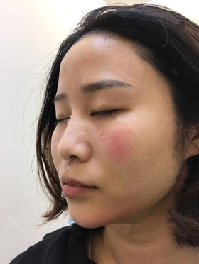 记录了玻尿酸填充泪沟手术前后过程，还有前后对比图哦