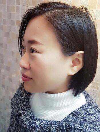 武汉中爱注射瘦脸去鱼尾纹一个月