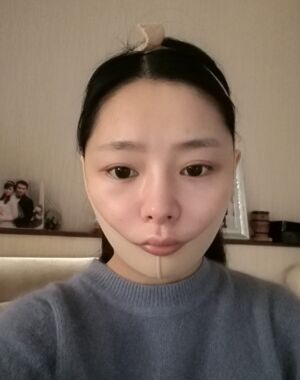 广州曙光刘永波做的双下巴吸脂后脸型好看多了