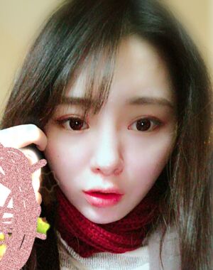 广州曙光刘永波做的双下巴吸脂后脸型好看多了