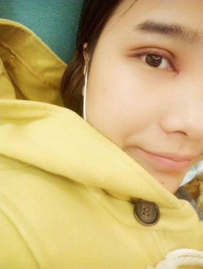 全切双眼皮让我告别肿泡眼变女神