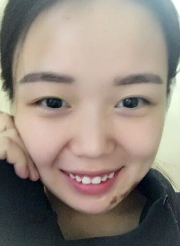 激光祛疤痕整形手术真的改变了我的人生