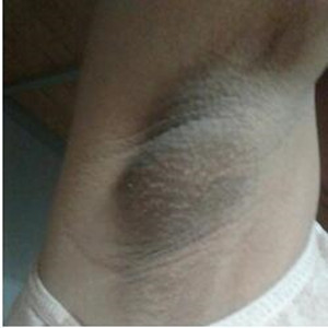 我自身去狐臭的真实经历 你不去试过怎么会知道果了