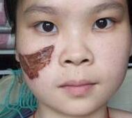 激光去胎记——长达一年的激光太田痣青色胎记缓解过程分享