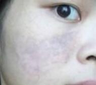 激光去胎记——长达一年的激光太田痣青色胎记缓解过程分享