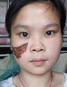 激光去胎记，去大田痣