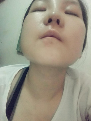 做了隆鼻整形手术，给大家分享一下手术过程，还有对比照片哦