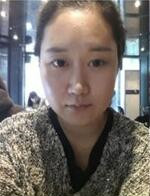 分享下颌角整形手术前后过程，还有对比照哦