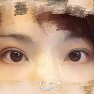 做了眼部电波l皮，一下子年轻了不少啊
