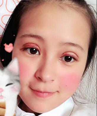 梨花雨割双眼皮恢复半年了